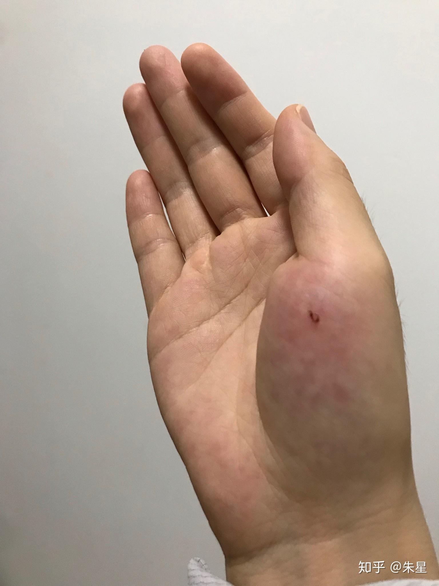 被马蜂蛰了怎么办