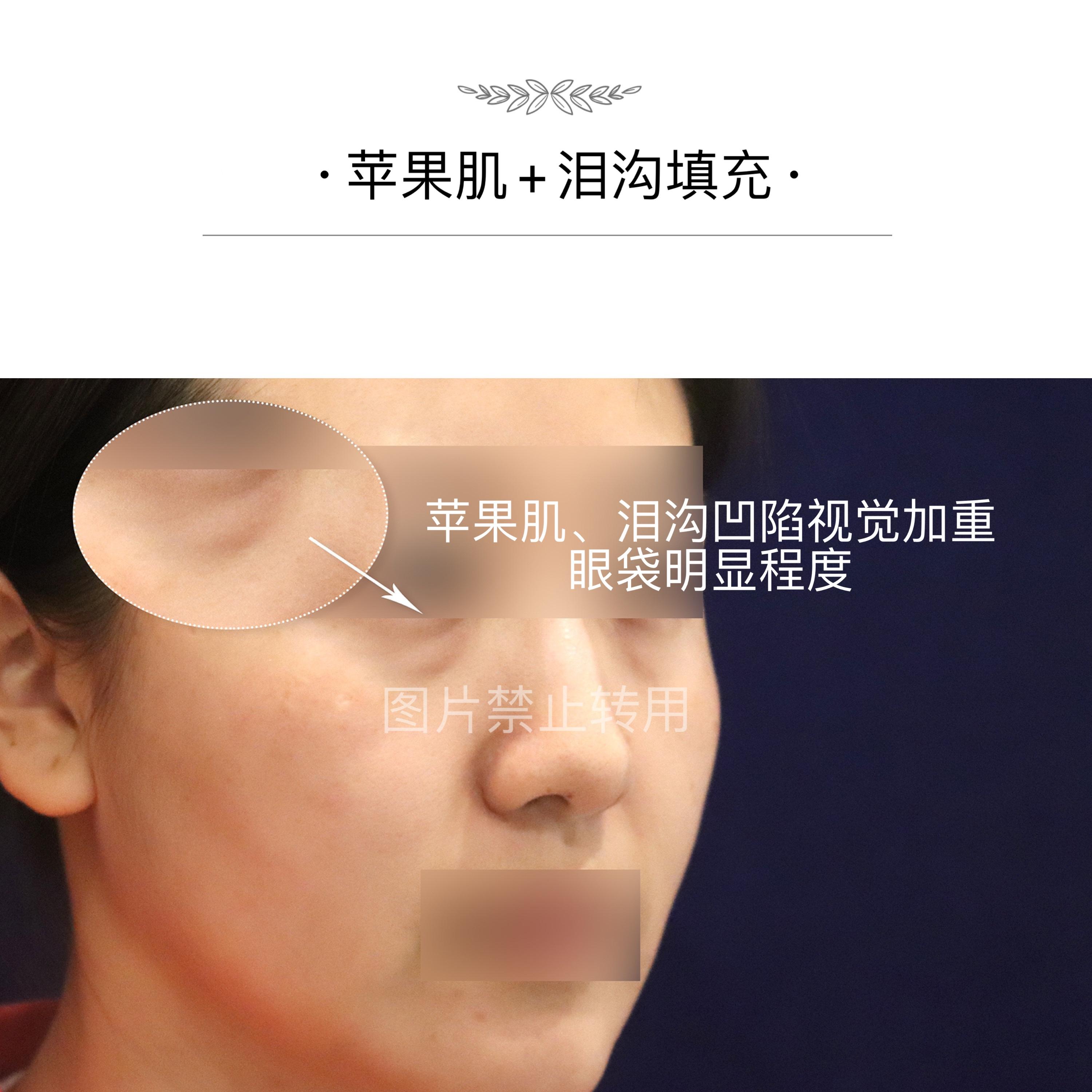 北京眼袋泪沟：关于眼袋、泪沟一次性讲清楚 - 知乎