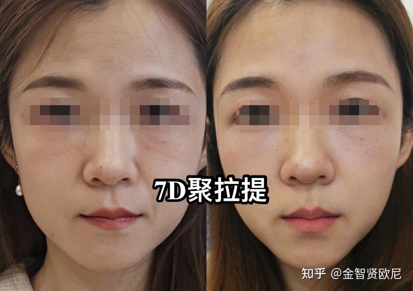 垮脸必看医美抗衰最强干货盘点一热玛吉欧洲之星fotona4d热拉提7d聚拉