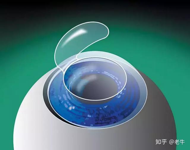 激光磨削,保留一丢丢连接,掀开这个角膜瓣,再对角膜基质进行但不切断