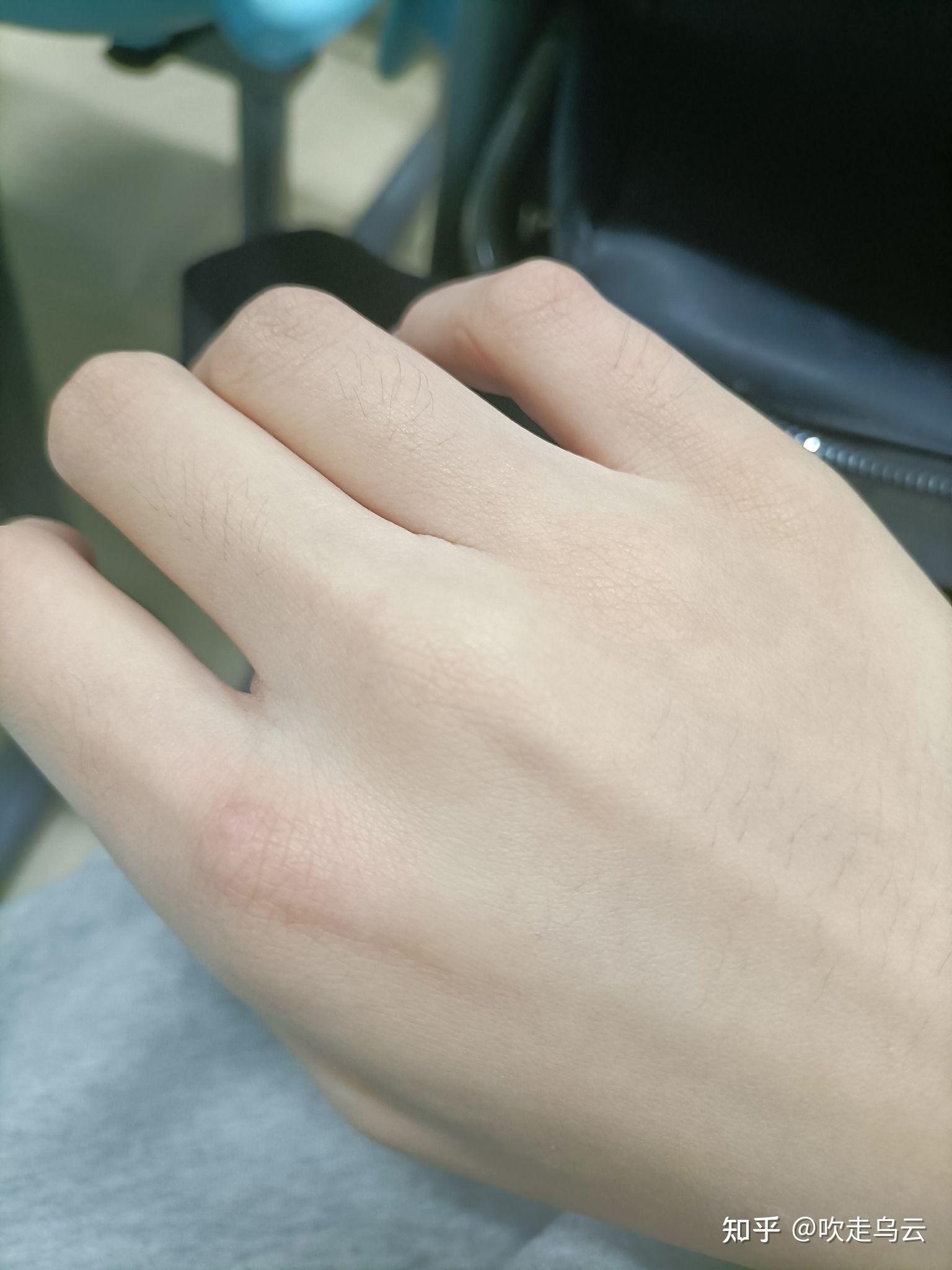 催吐一定有疤吗? - 知乎