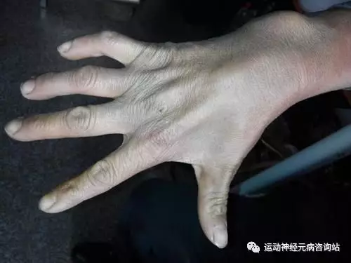不同类型肌肉萎缩的不同症状 知乎 不同类型肌肉萎缩的不同症状 知乎