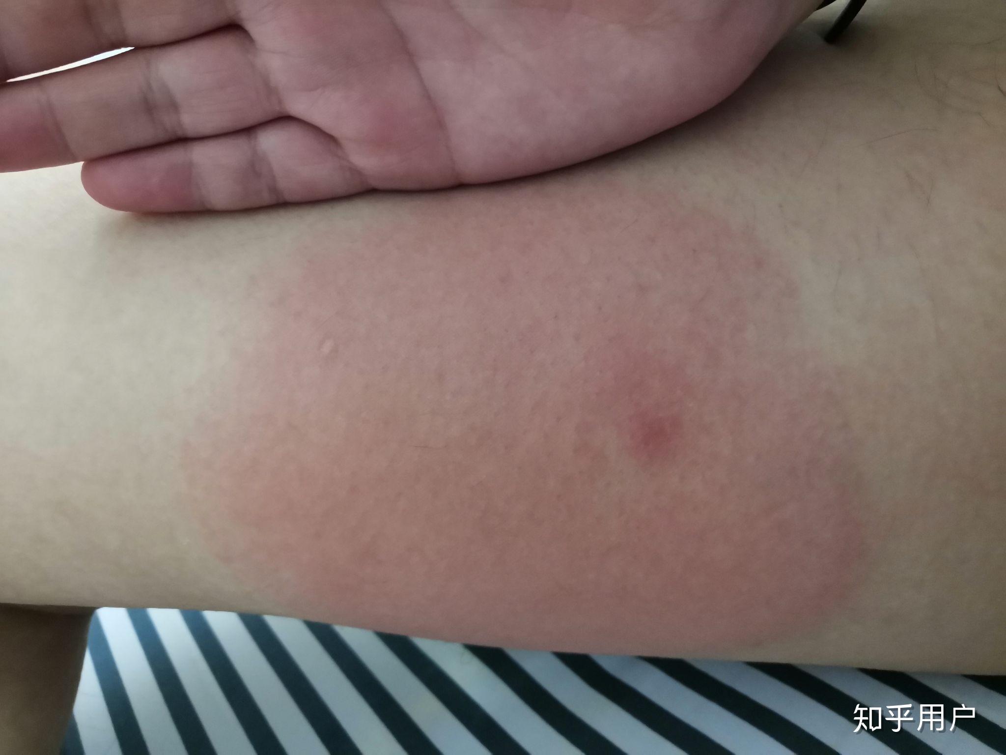 被虫子咬了,红肿一大片,好像有扩张的迹象,很痒,温