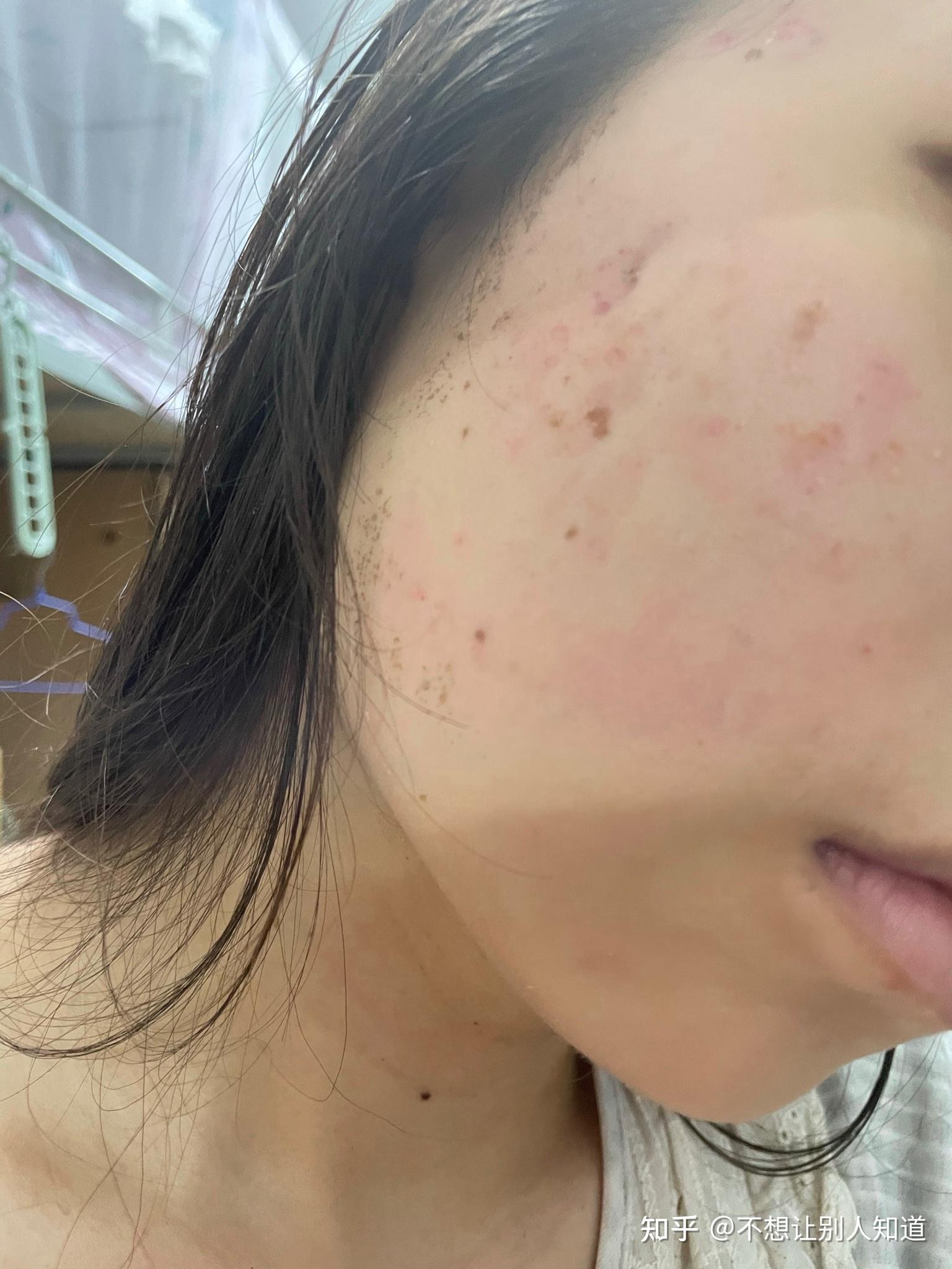 激光点阵广州番禺省中医院