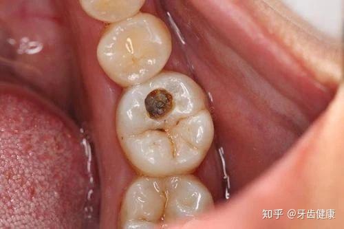 补过的牙齿还会蛀吗