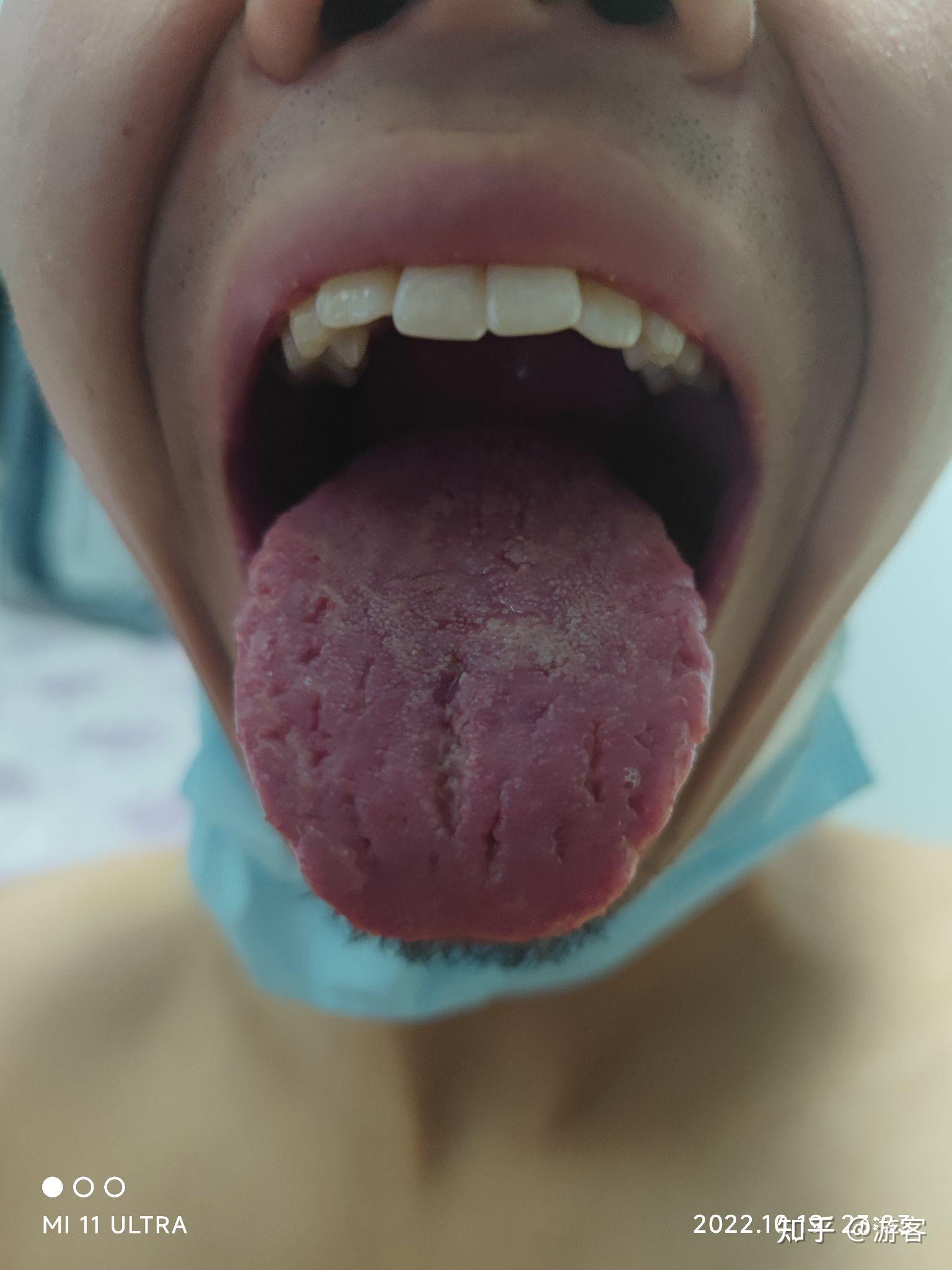 【病例解答】齿痕舌，裂纹，舌像破了似的总有辣丝丝的，牙总咬到舌两侧和前面难受。一遇凉就感冒，咳嗽，总有黄痰