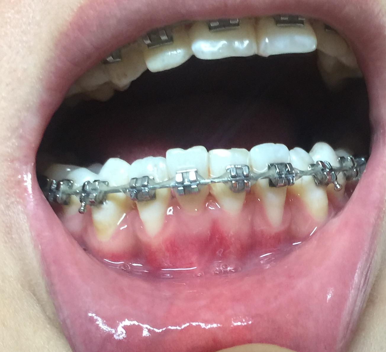 我想问一下有没有人矫正牙齿之后牙龈萎缩的,有没有什么好办法啊?