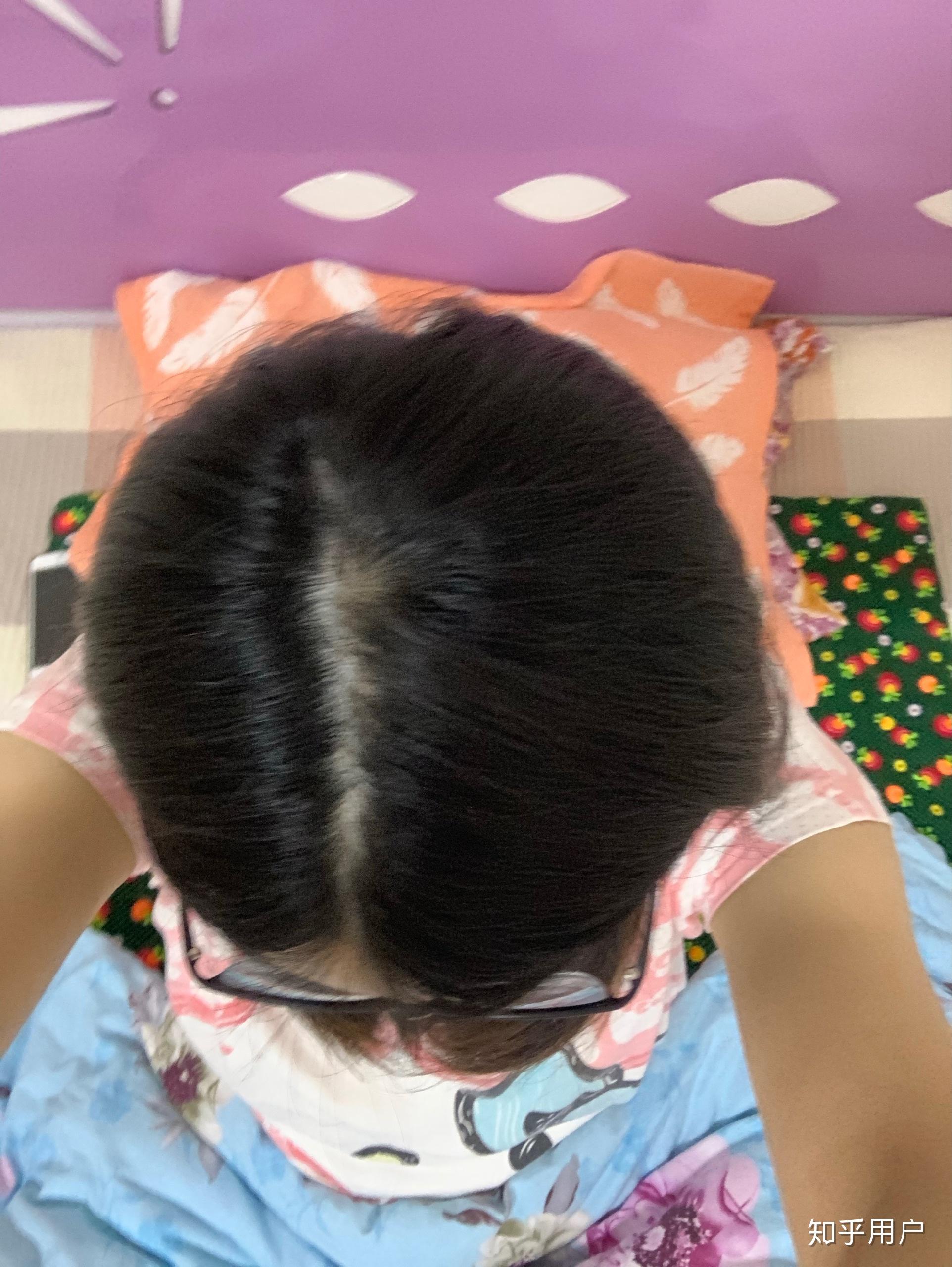 女生头顶头发少是什么体验