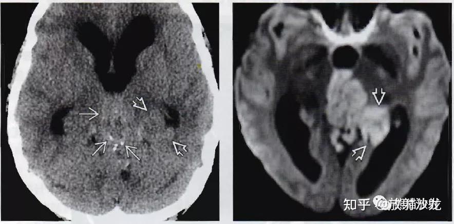 松果体瘤、松果体母细胞瘤丨影像诊断要点 - 知乎