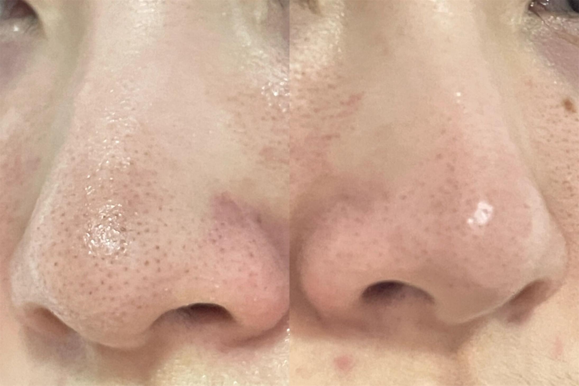 水杨酸可以去鼻子上黑头和t区毛孔粗大吗怎么使用一天几次