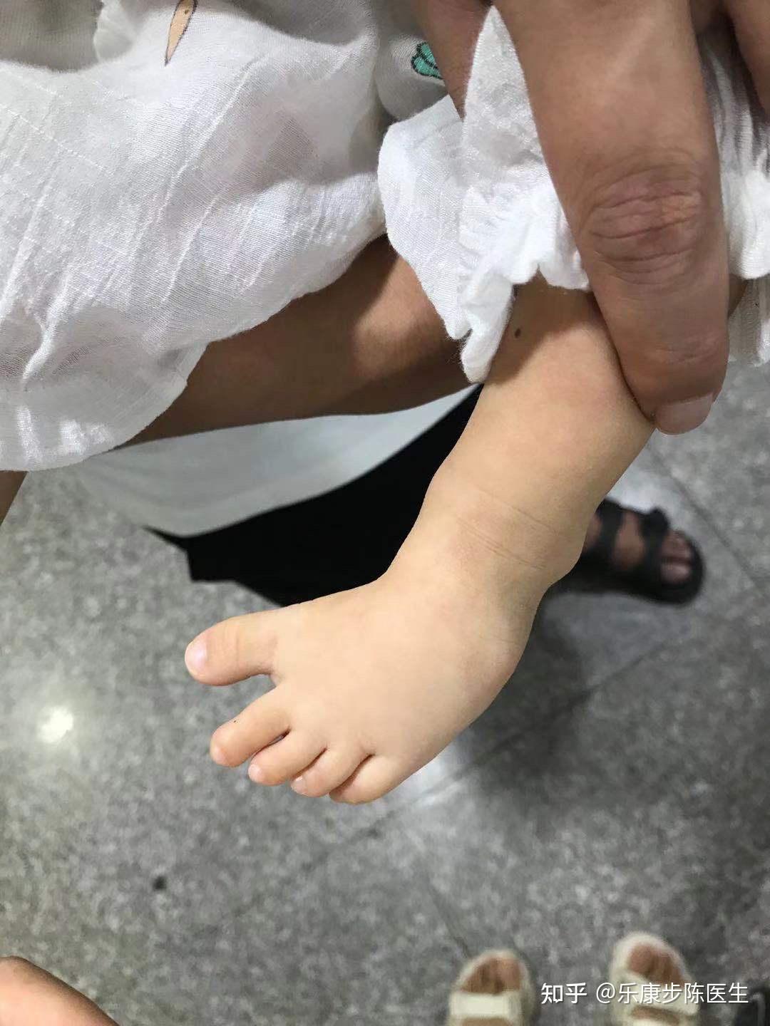 婴幼儿单侧肢体肥大图片