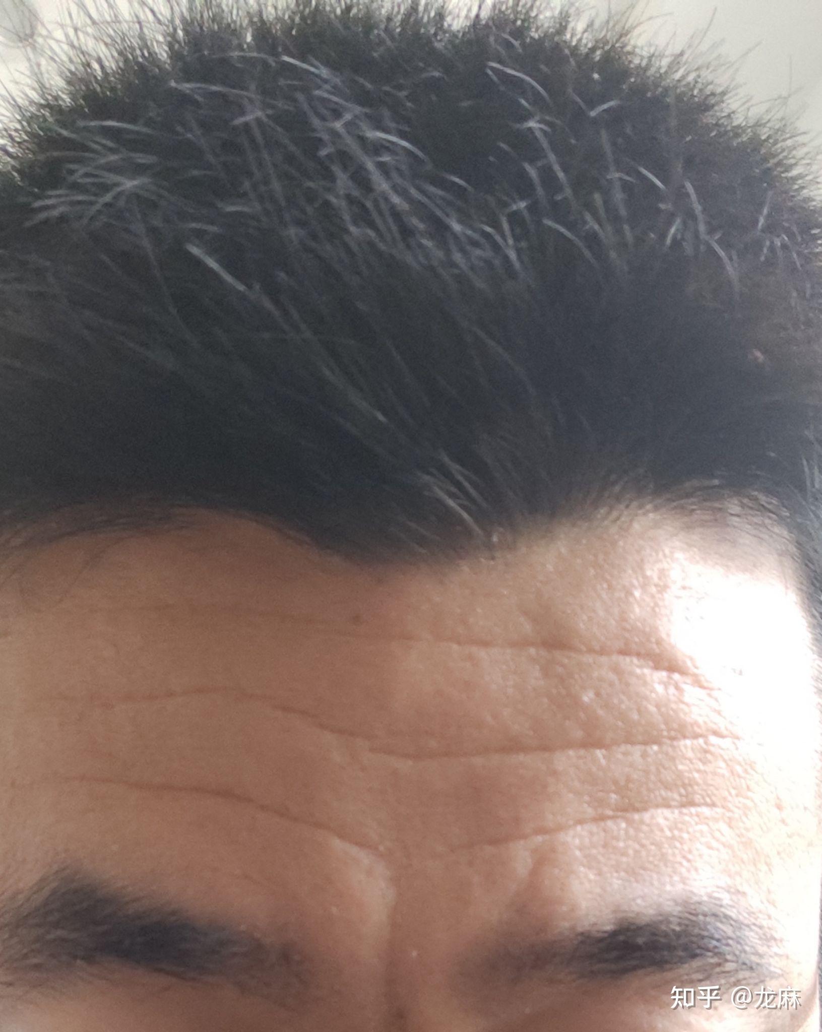 请问这抬头纹还有救吗(16岁)? - 知乎