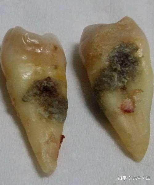 为什么牙龈萎缩牙槽骨吸收不可逆