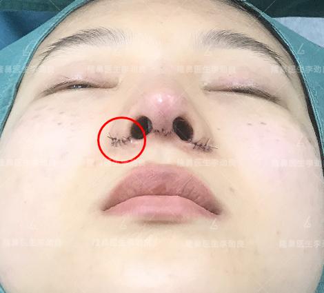 鼻翼缩小手术是不是失败了