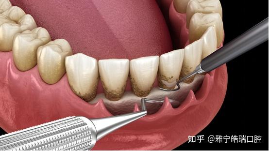 龈下刮治术是用比较精细的龈下刮治器刮除位于牙周袋内根面上的牙石和