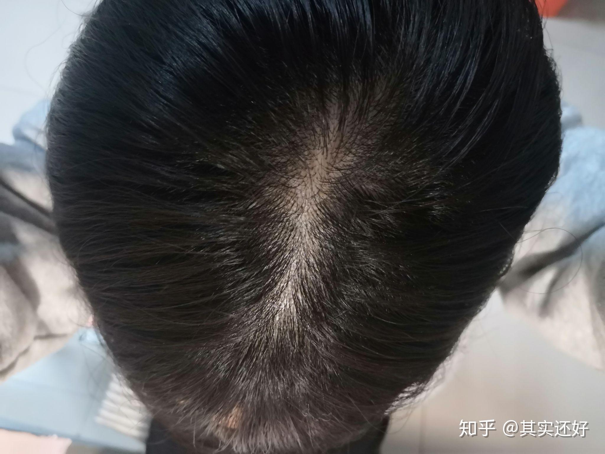 我的发缝正常吗?