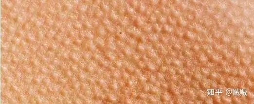 鸡皮肤是因为太油还是太干(鸡皮肤是因为太油还是太干燥) 鸡皮肤是因为太油还是太干(鸡皮肤是因为太油还是太干燥)