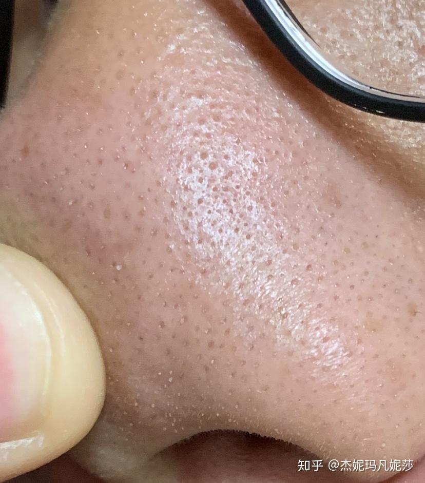 鼻子上面挤出的油腻的白点点颗粒到底是什么