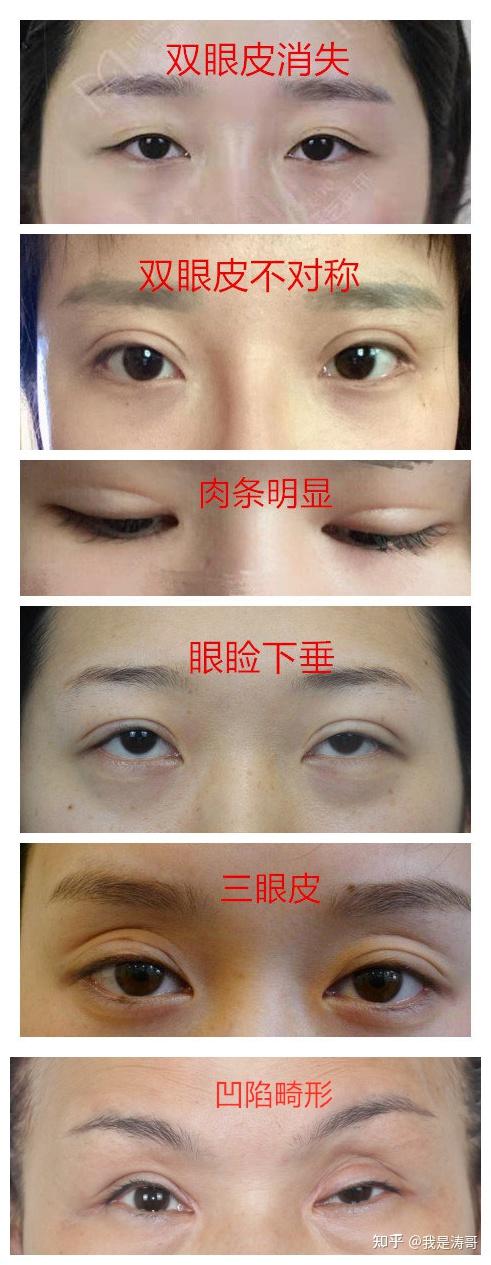 为什么割了双眼皮也不好看