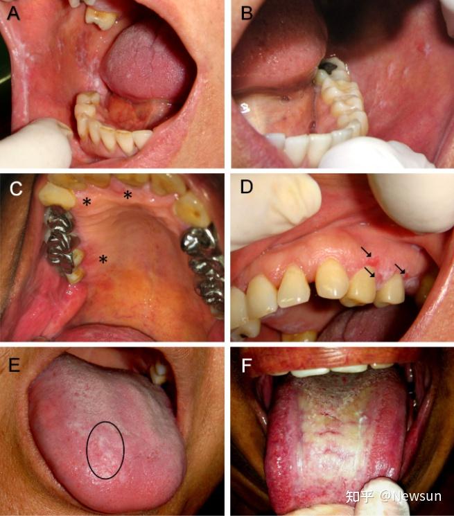 hpv感染口腔的表现图片图片