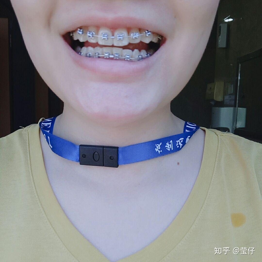 93年方脸妹子正畸之旅