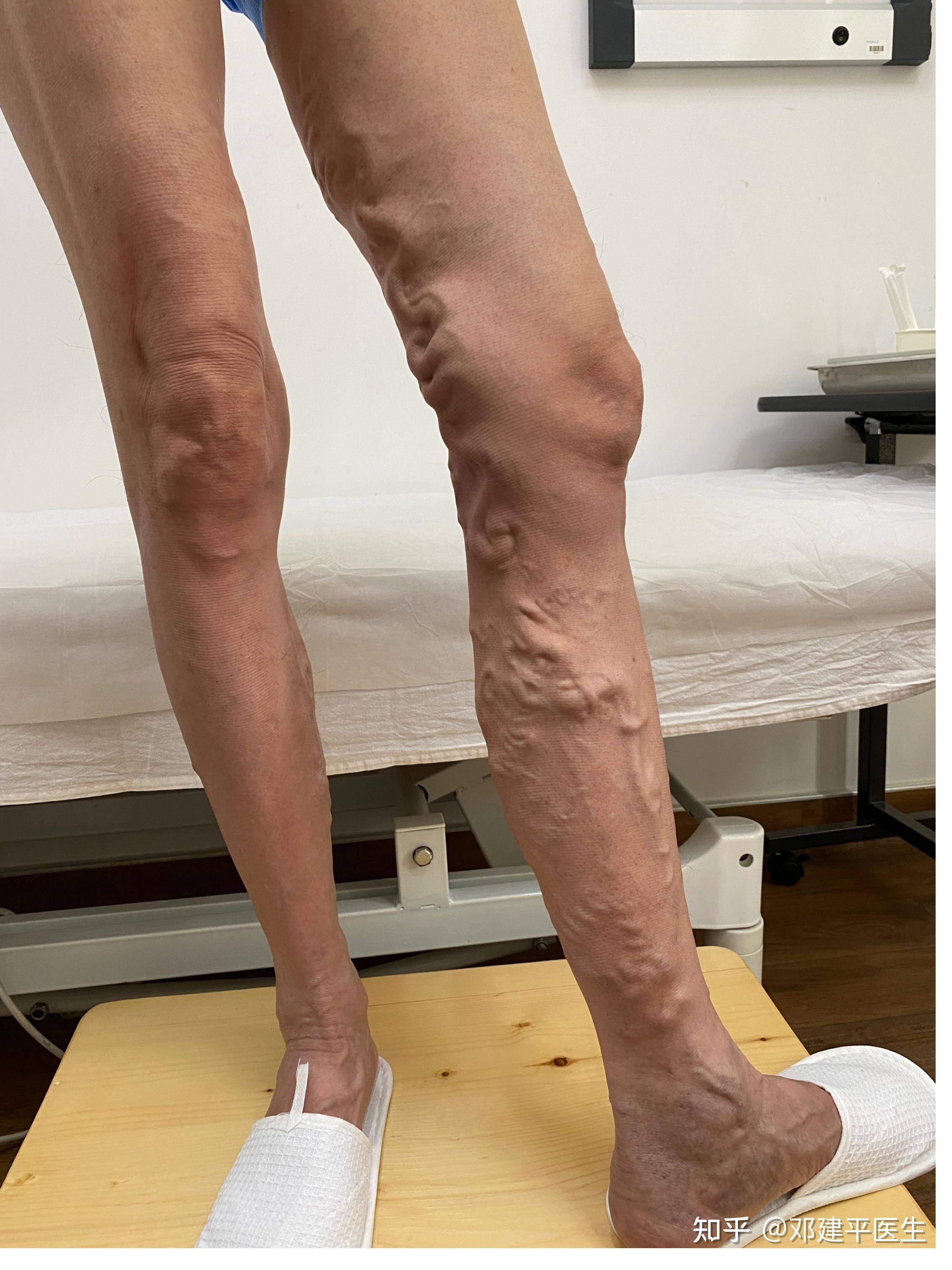 静脉曲张怎么改善怎么缓解症状