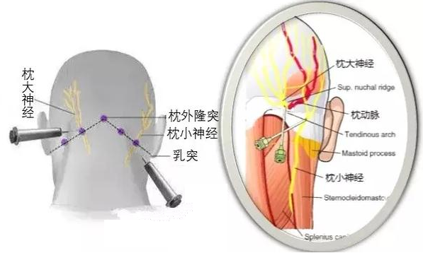 头痛一定是头的问题吗 枕大神经卡压综合征 一种不容忽视的头痛 知乎