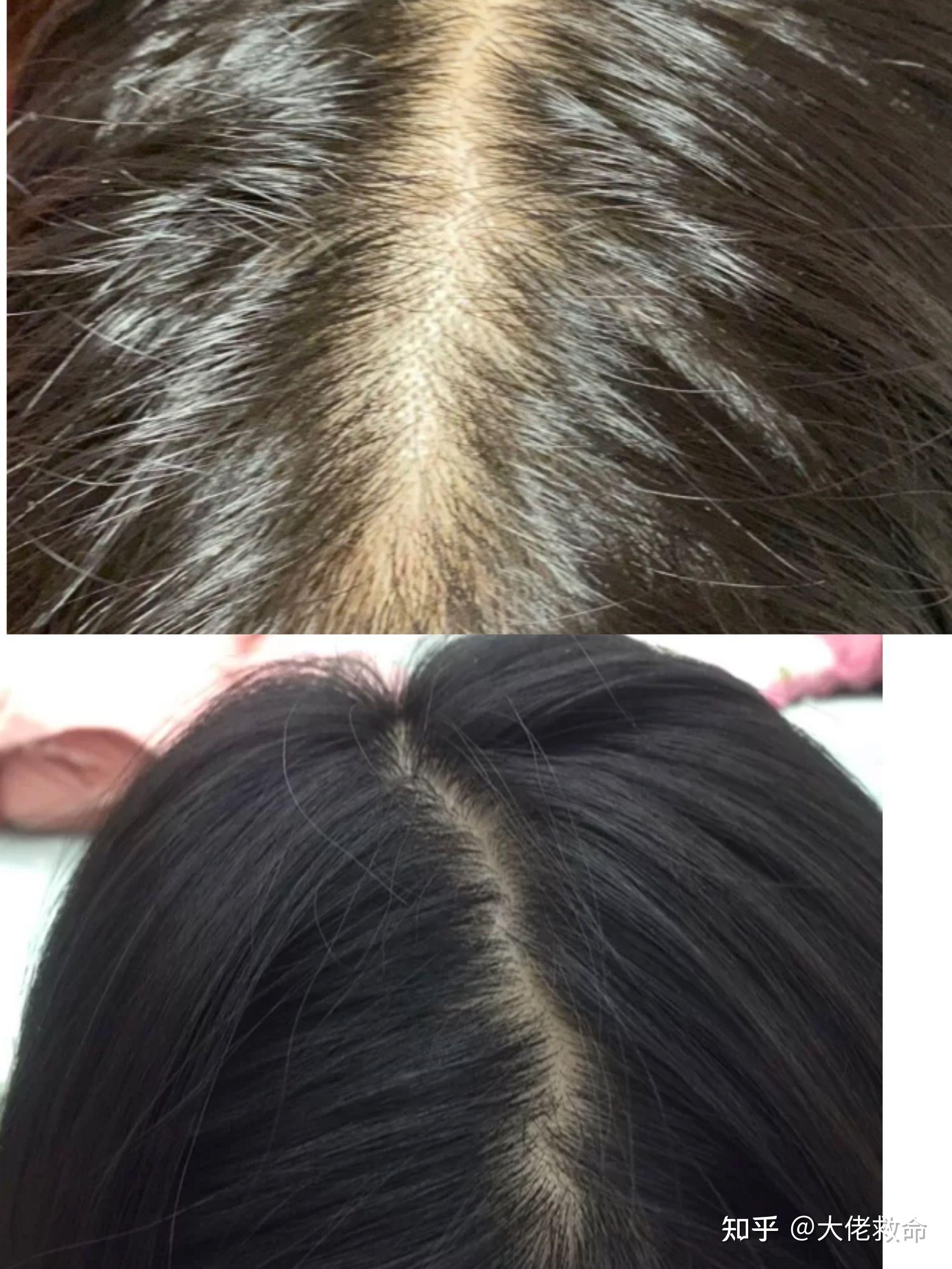 一,滋养毛囊,出现小绒毛