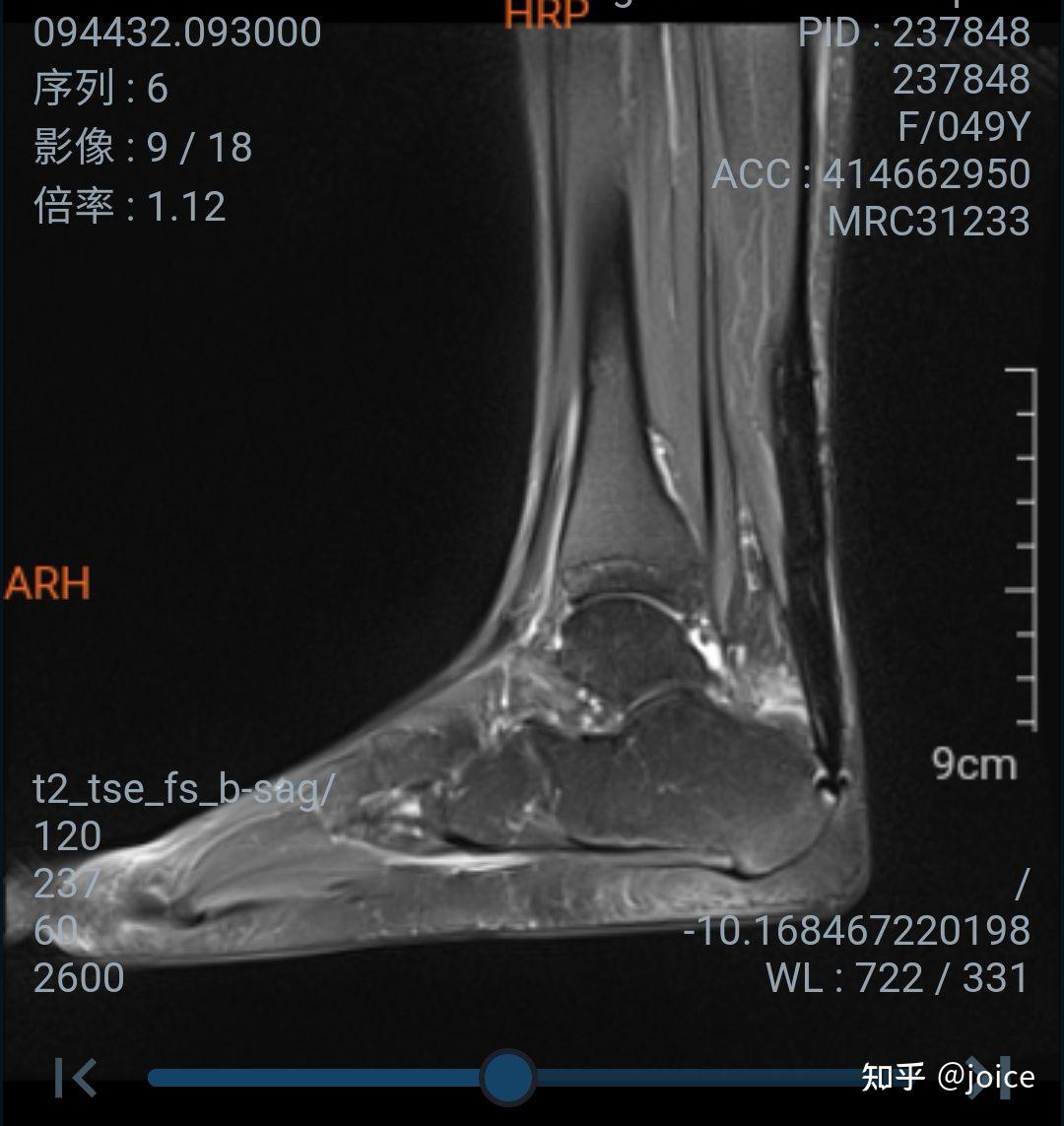 《小巨人运动会》刘翔晒跟腱术后伤疤：痛，真的痛 -- 眼界，放眼世界