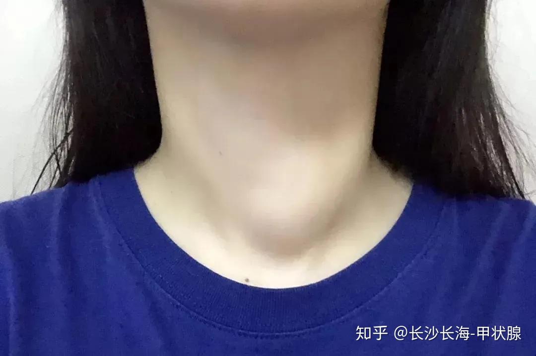 ①甲状腺肿大:甲状腺肿大,其实就是指脖子肿大.