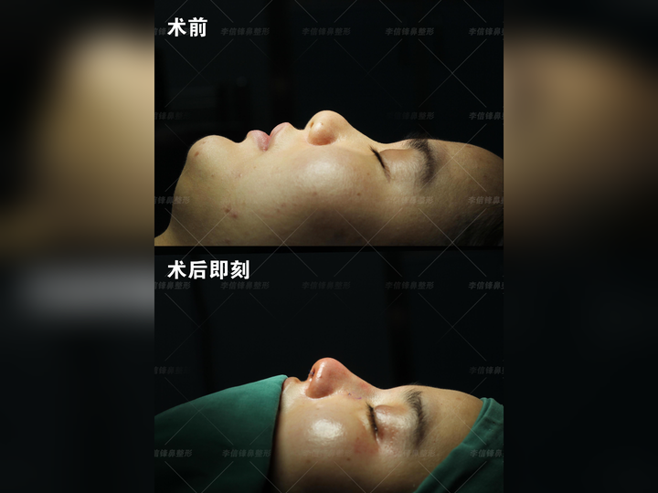 塌鼻子,大鼻头困扰?解决办法在这里。 - 知乎