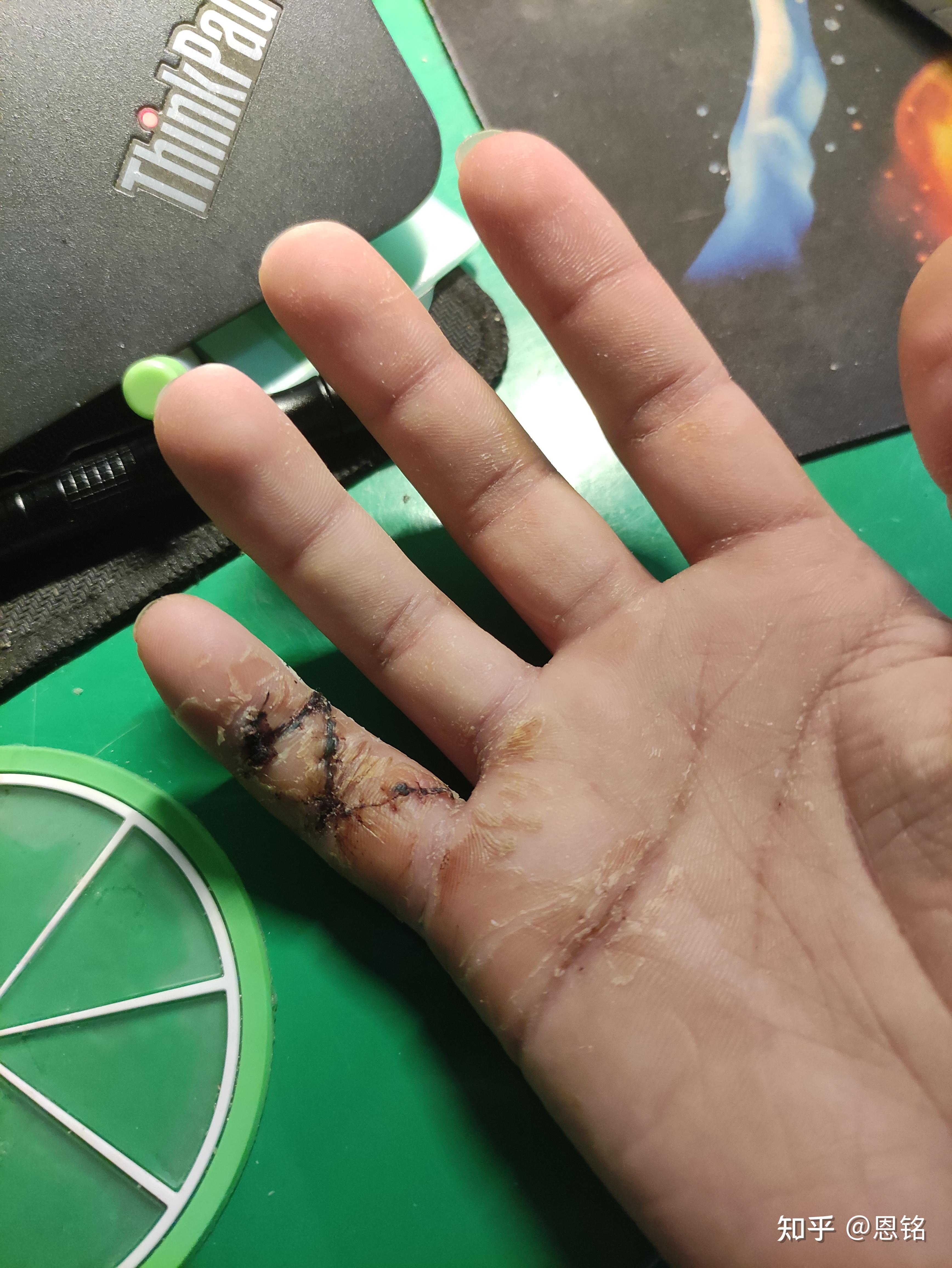 手指肌腱断裂最后一节无法伸直医生教我不要治疗了请