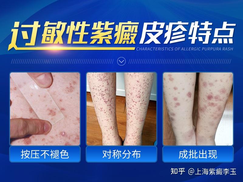 过敏性紫癜和“皮炎”的区别是什么?教你一眼识别! - 知乎