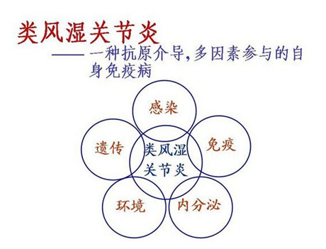 病因不明的类风湿关节炎