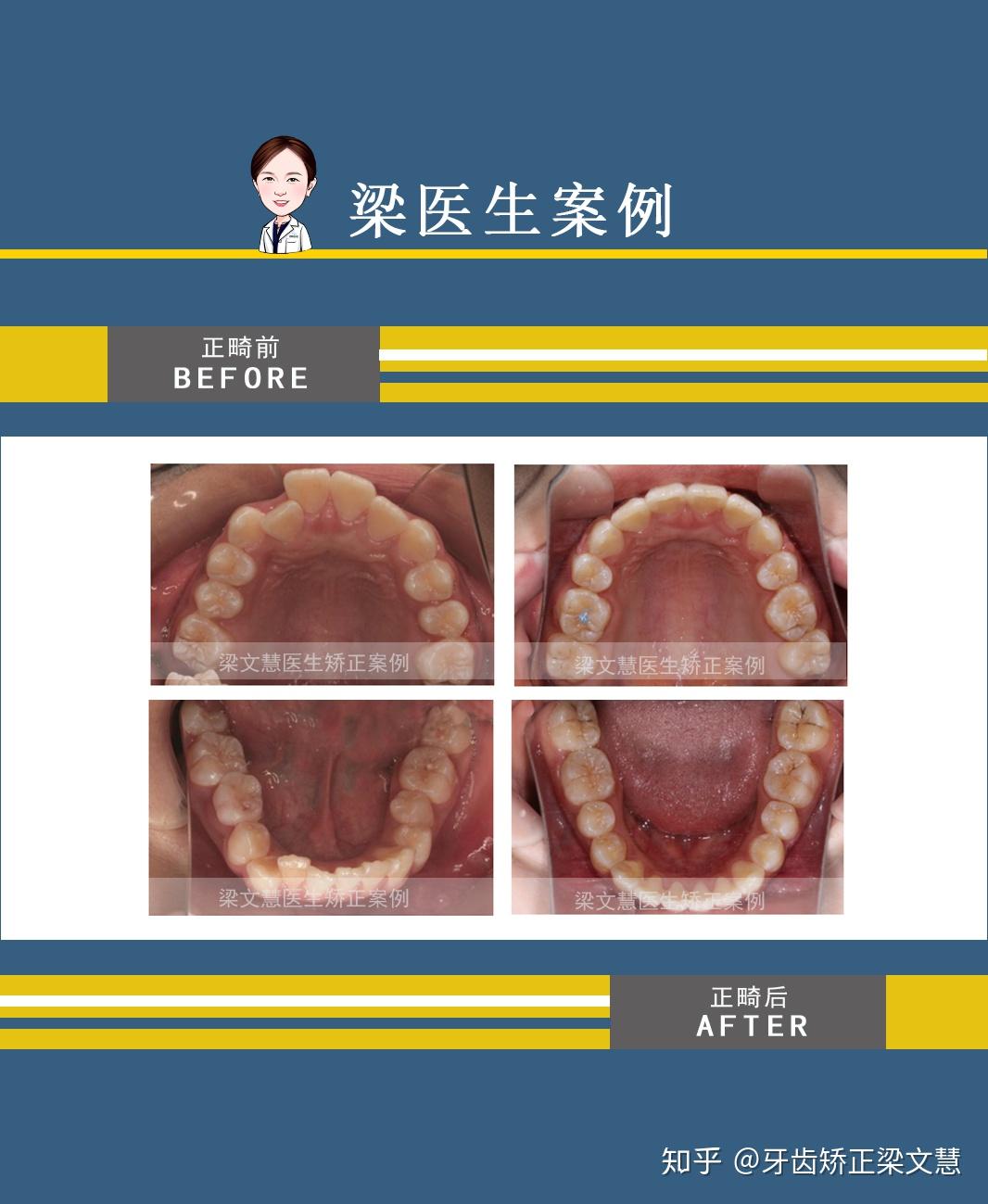 上下牙数量不一样会怎样? 