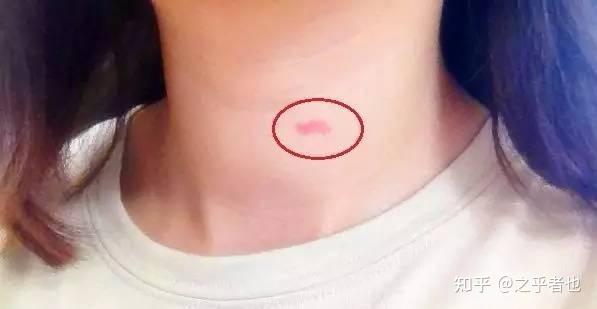 67脖子上种草莓真的有可能致命恩爱有风险下口需谨慎