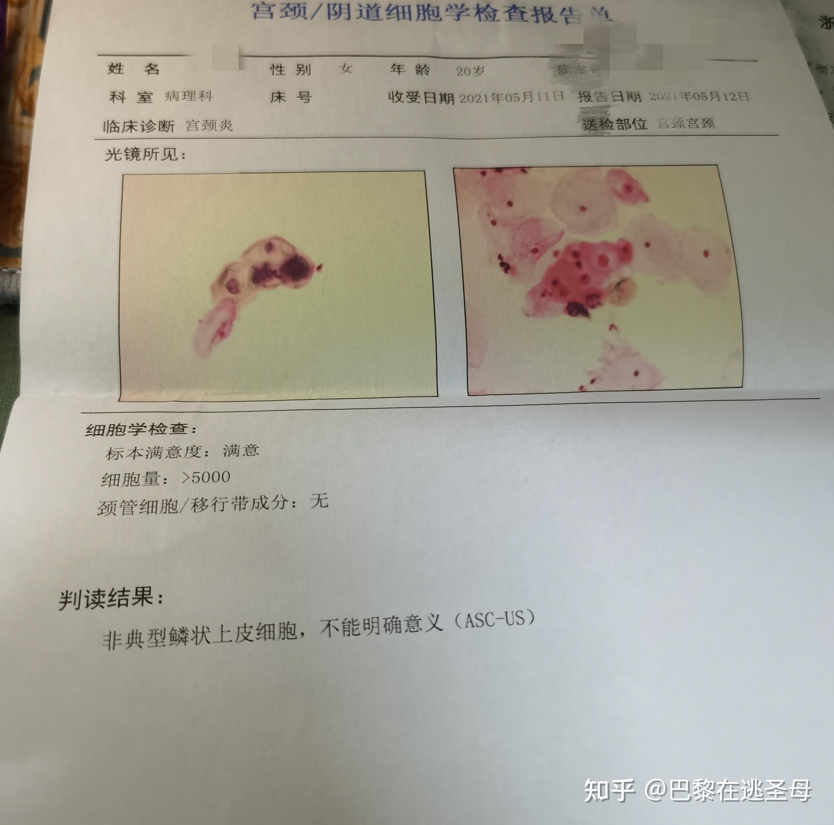 兩天後tct結果出來了是非典型鱗狀上皮細胞,不能明確意義(asc-us)