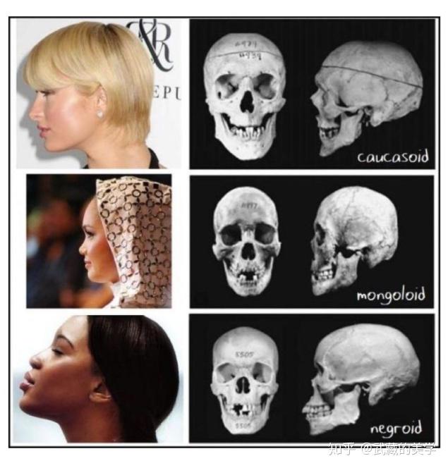 可以看到面中高的不只是一小块,是下图所圈的一整块拔出来,包括眼眶骨