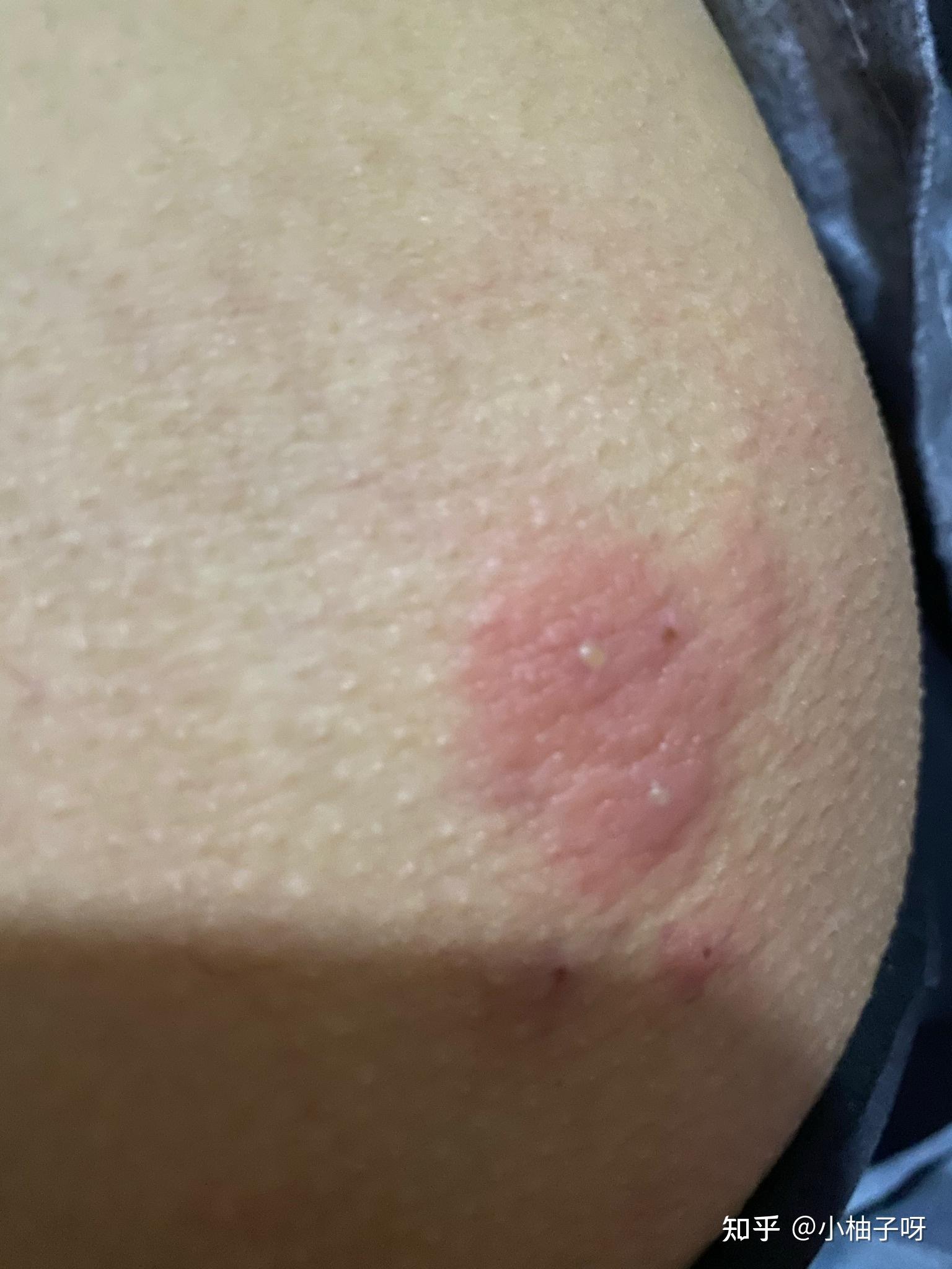 屁股上长了一片小红痘痘,还有脓包