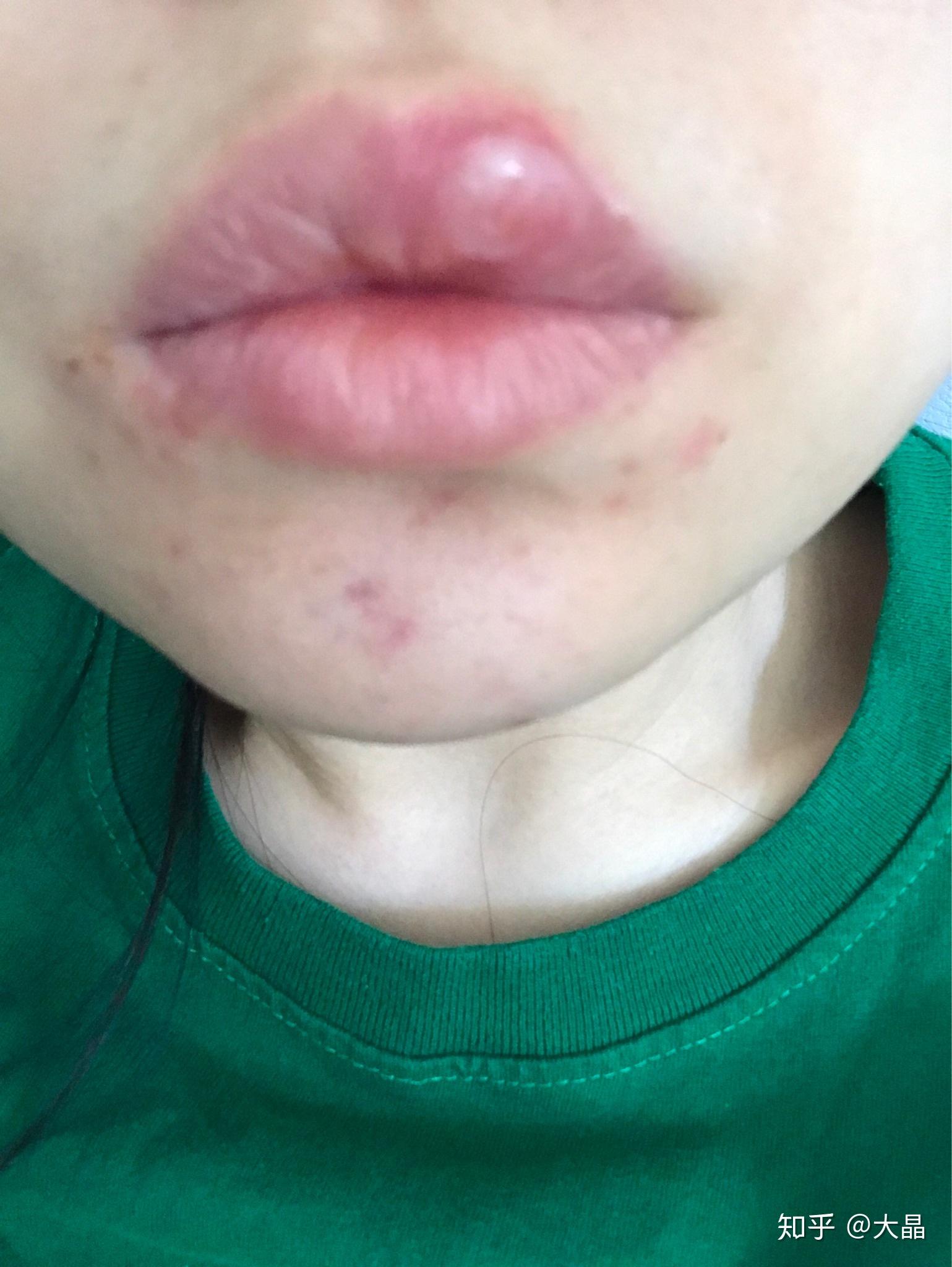 为什么人的嘴唇会起泡? - 知乎