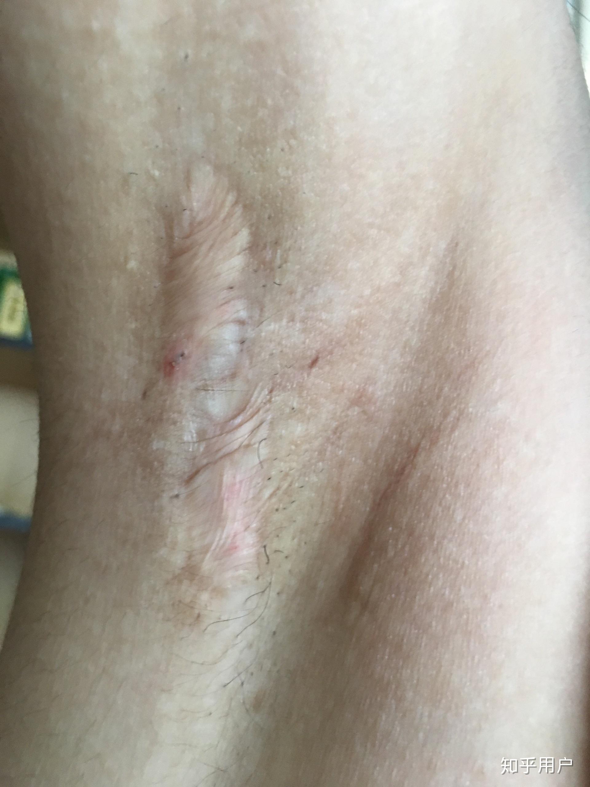 腋臭手术疤痕怎么去除或者淡化? - 知乎