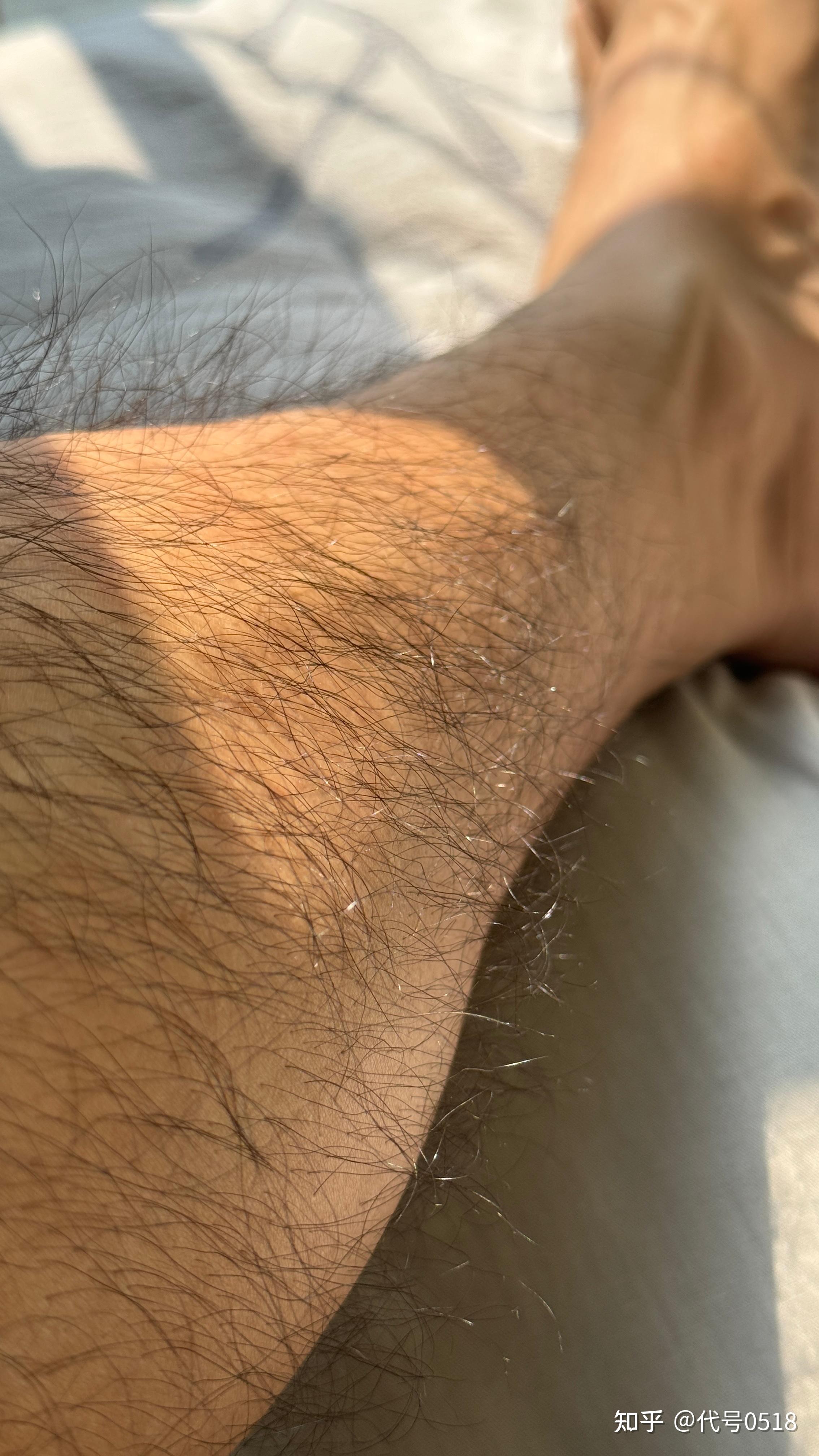 男生腿毛浓密怎么办?