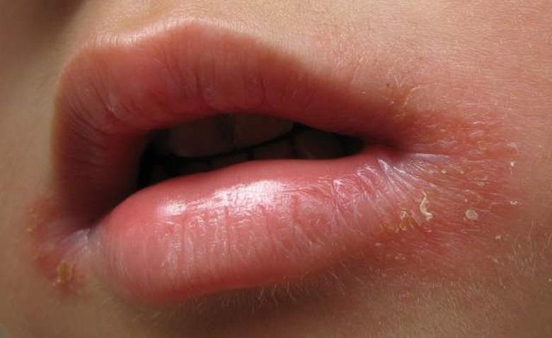 秋季孩子口角炎原因只是缺少维生素 医生 3个原因你有忽视吗 知乎 秋季孩子口角炎原因只是缺少维生素 医生 3个原因你有忽视吗 知乎