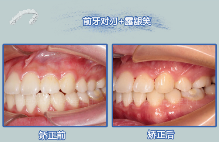 西安牙齿矫正前牙对刃露龈笑改善