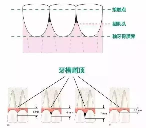 牙齒上出現黑三角可能你的牙齦正在萎縮