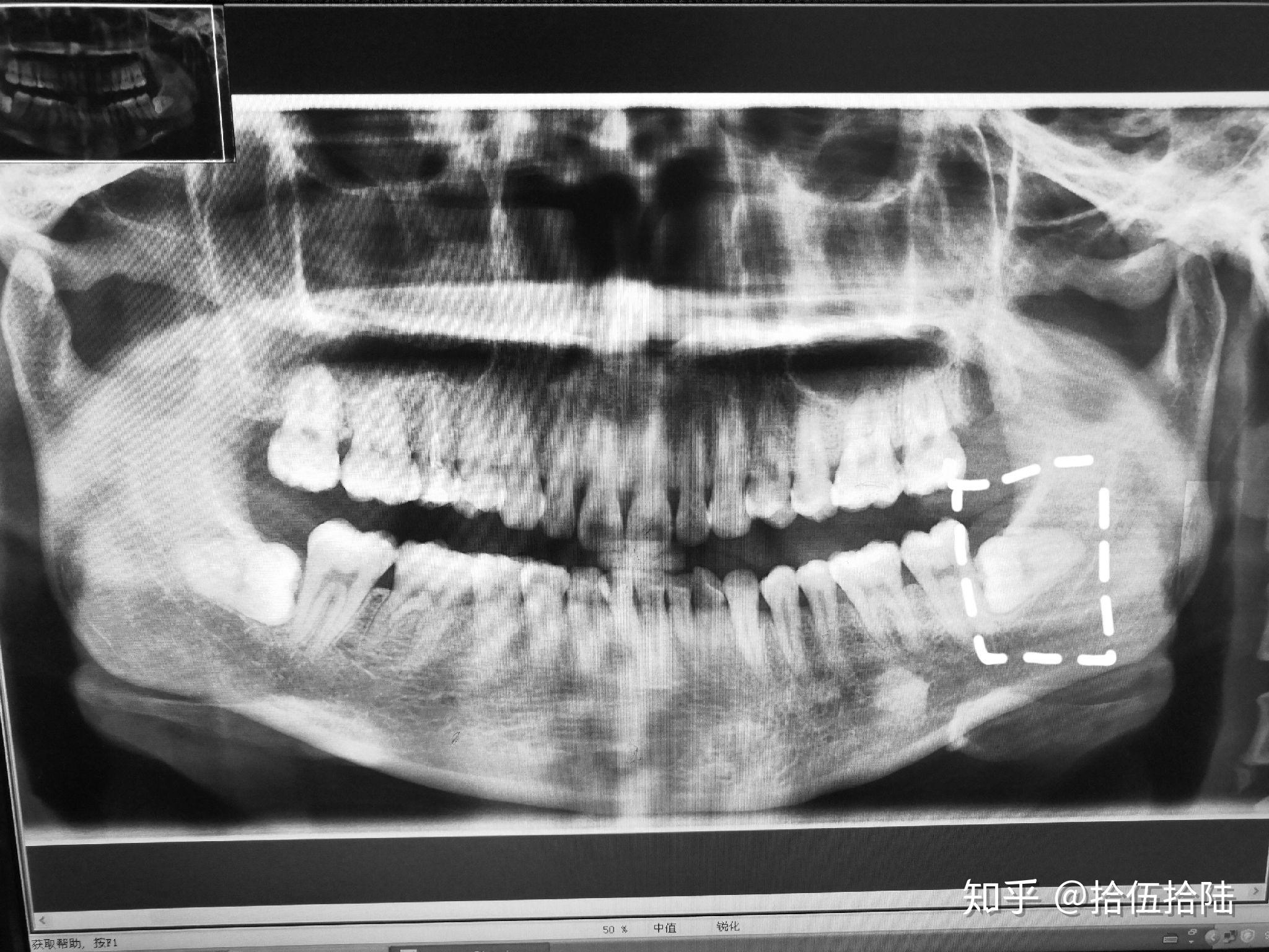 低位水平阻生齿,医生说要住院全麻,费用将近2w,不知道该怎么办?