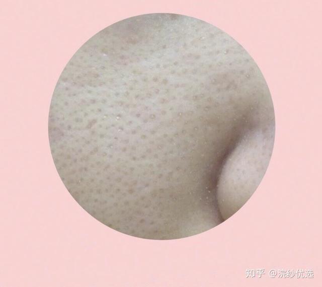 什么是角质?角质厚长什么样? - 知乎