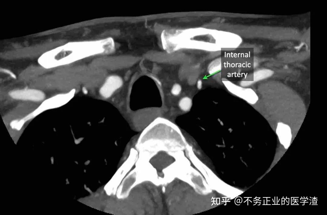 内乳淋巴结ct片图解图片