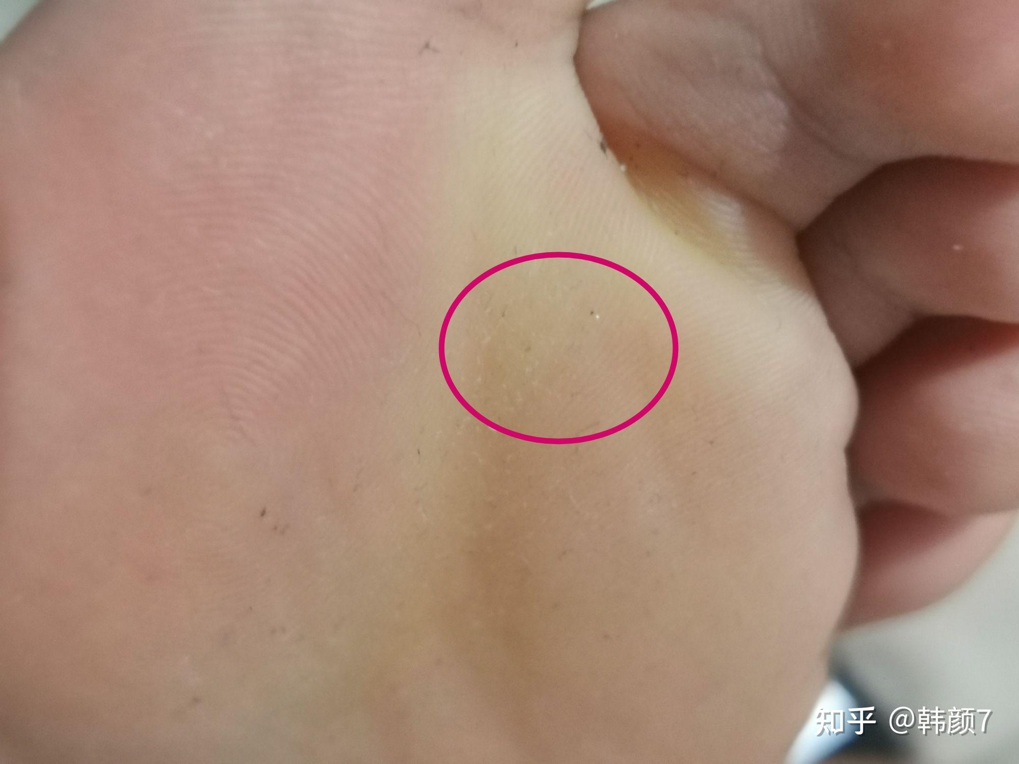 怎么治脚上跖疣已治愈历时七个月