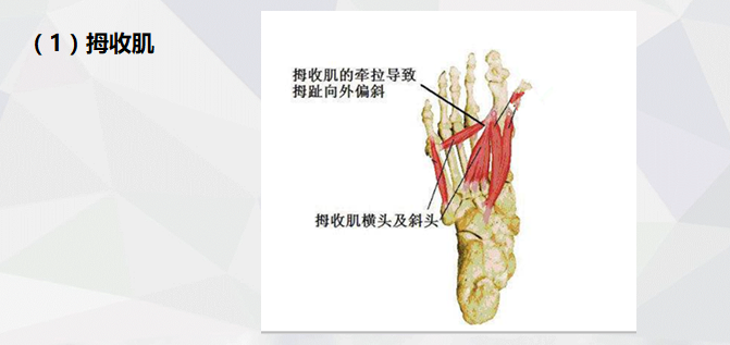 拇外翻的自我纠正
